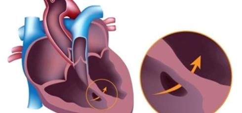 Illustration souffle cardiaque