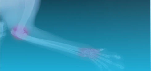 Illustration polyarthrite