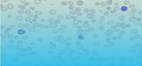 Illustration anémie hémolytique à médiation immune