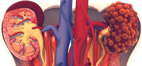 Illustration Insuffisance Rénale Chronique